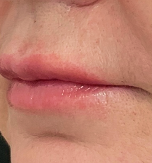 After treatment