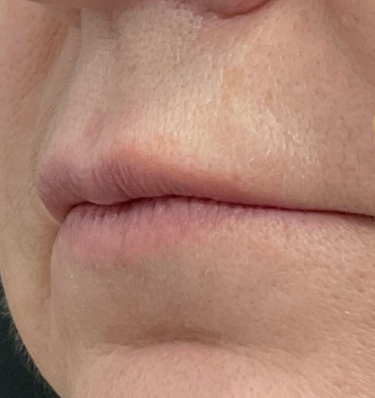 Before treatment