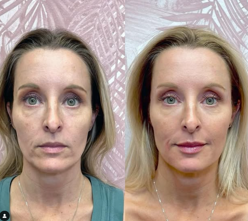 Before treatment
